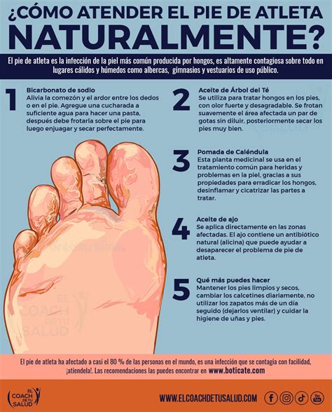 Pie De Atleta Ingles at Nancy Hansen blog