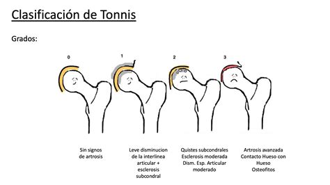 Artrosis de Cadera | Dr. Olivetto