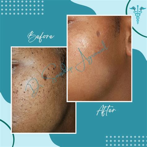 Treatment Gallery - Dr. Sandip Agrawal