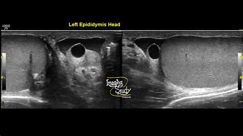 Epididymal Cyst Ultrasound
