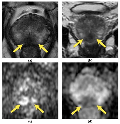 Prostate Cancer and Its Mimics—A Pictorial Review