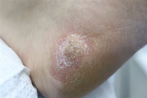 Plantar Wart And Hpv at Joanne Vega blog