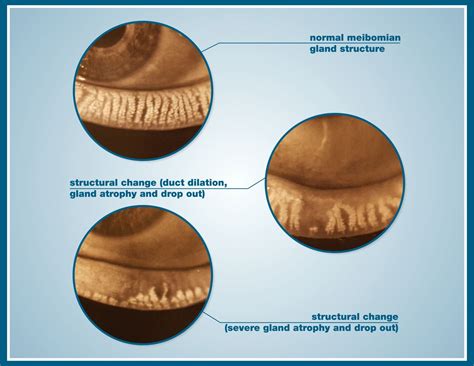 Meibomian Gland Dysfunction Columbia MD - Dry Eye Center of Maryland