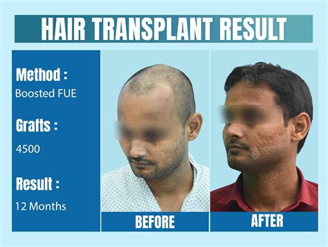 Top Hair Transplant Cost in Delhi NCR