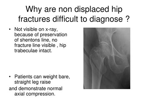 PPT - Ultrasound Diagnosis of Non-Displaced Hip Fractures PowerPoint Presentation - ID:9093587