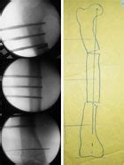 Oblique Plane Deformity