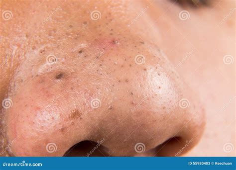 Ugly Pimples, Acne, Zit and Blackheads on the Nose of a Teenager Stock Image - Image of closeup ...