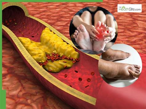 Clogged Arteries Symptoms: 7 Unusual Signs of Heart Blockage That ...