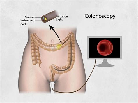 Image result for Colonoscopy Process