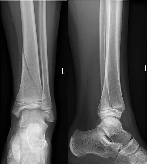 Fractures - Ankle