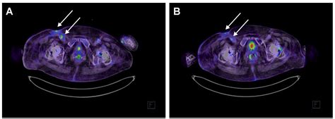 Phage–Antibiotic Combination Therapy against Recurrent Pseudomonas Septicaemia in a Patient with ...