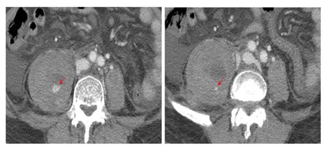 Lumbar Plexus Palsy Caused by Massive Psoas Hematoma Related to ...