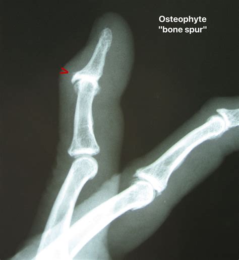 What Is A Bone Spur In Your Thumb at Coleman Stevens blog