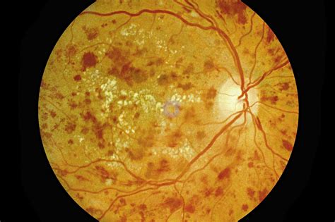 Proliferative Diabetic Retinopathy Neovascularization KoreaMed