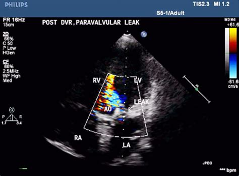 Device Closure of Aortic Paravalvular Leak – ASEAN Heart Journal
