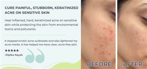 Buy Acne Care Kit For Dry & Sensitive Skin | Teenilicious