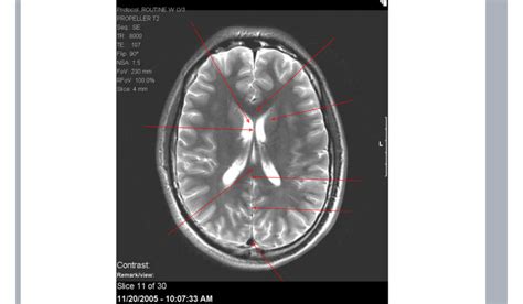 Brain CT Scan 的图像结果