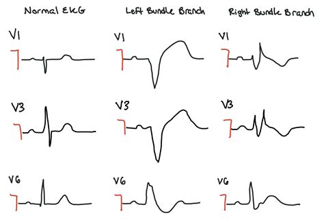 Bradycardia — When the Beat Drops: A Resident's Guide to the CCU
