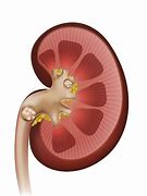 Image result for kidney stones