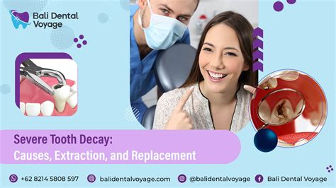 Severe Tooth Decay: Causes, Extraction, and Replacement
