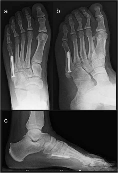 Anatomic variants affecting the surgical treatment of Jones fractures: A report of 3 cases ...