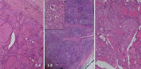 Revisitation of thyroid lesions in natives from hilly region: A four ...