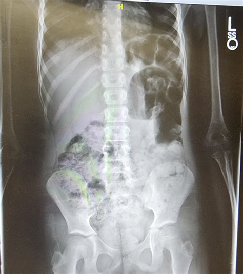 X Ray Of Severe Constipation Case Of A Woman With Severe Constipation