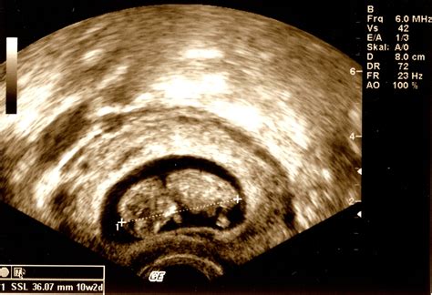 10 week old fetus - ultrasound image - DocCheck
