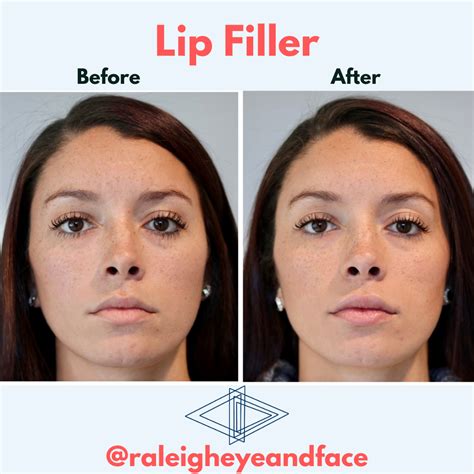 Raleigh Eye and Face Plastic Surgery - Raleigh Eye and Face Plastic Surgery - Serving Raleigh ...