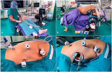 Surgical Technique and Implementation of Total Minimally Invasive (Laparo-Thoracoscopic) Ivor ...