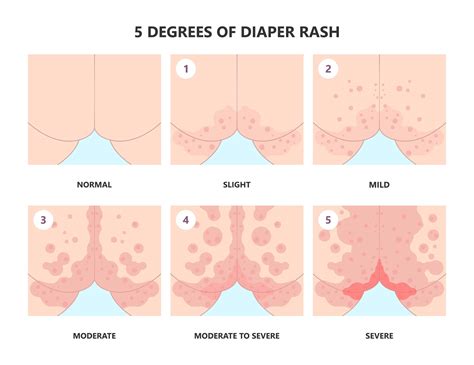 What Causes Diaper Rash
