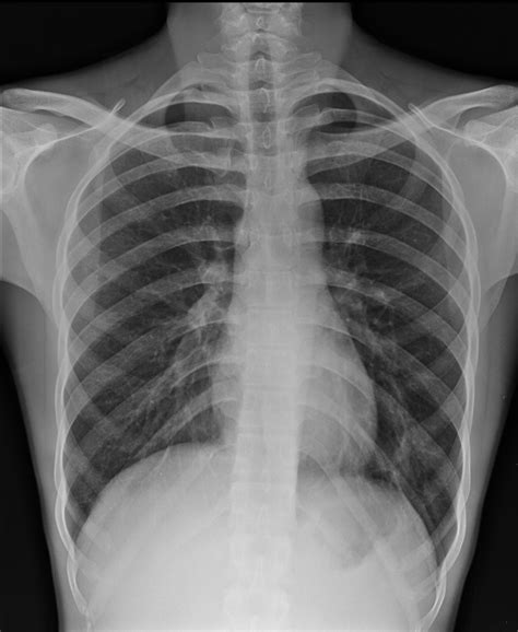 Xrays Of Broken Ribs X Rays Of Rob Pike's Shoulder