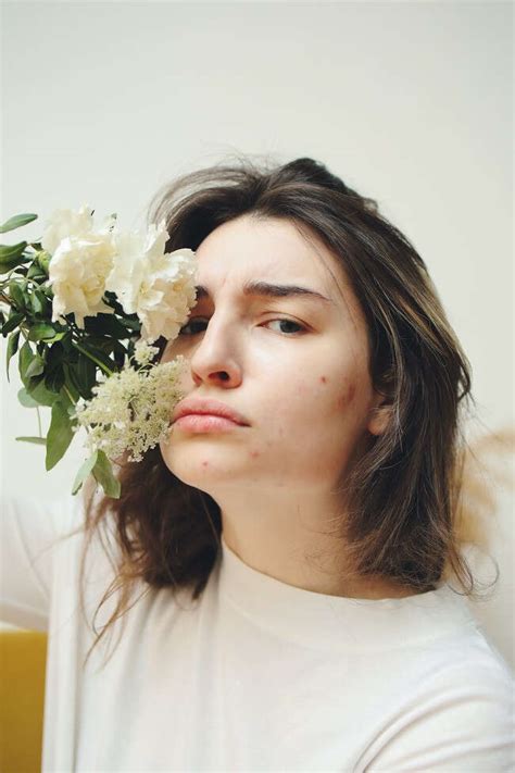 Acne-Prone Skin Deserves TLC Too: The Importance of Moisturizing ...