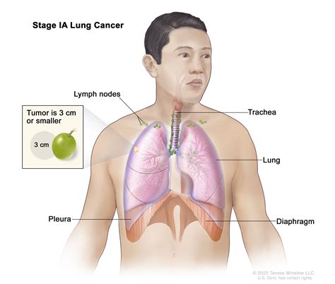Paratracheal Lymph Nodes Lung Cancer