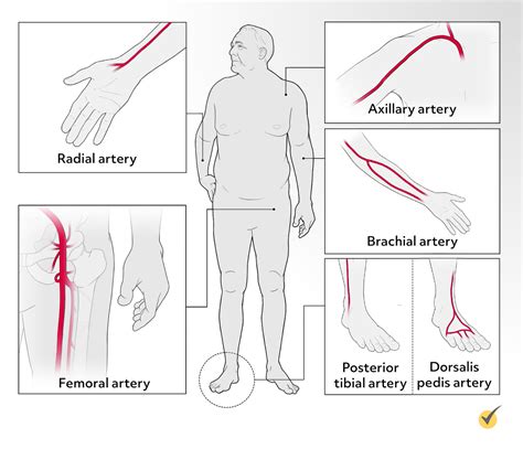 Radial Arterial Line