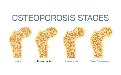 What is Osteopenia? - Comprehensive Primary Care