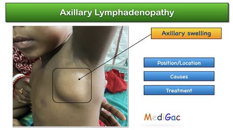 Axillary lymphadenopathy – Position/Location | Possible causes ...