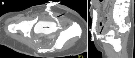 Image result for CT Cystogram vs Urogram