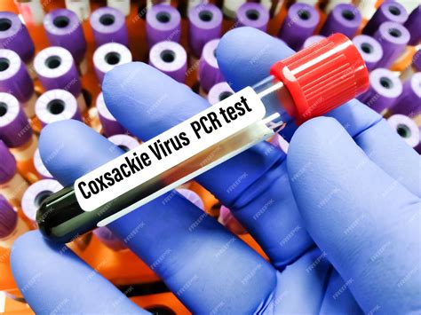 Premium Photo | Blood sample for Hand, foot, and mouth disease (HFMD) test. It is a highly ...