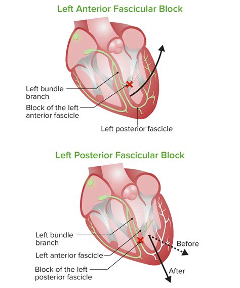 Bundle Branch and Fascicular Blocks | Concise Medical Knowledge