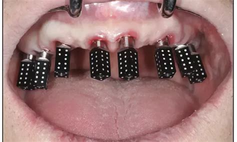 Photogrammetric Systems Outperform Traditional and Intraoral Methods in ...