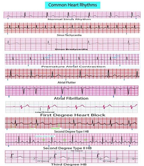 Printable Ekg Strips