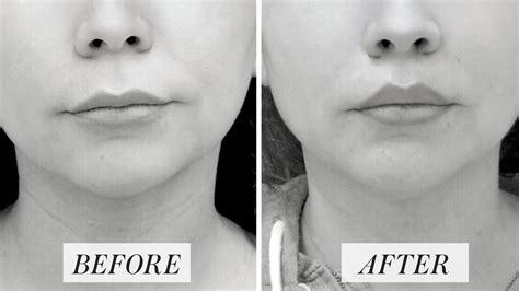 What Is a Lip Lift? Doctors Explain the Plastic Surgery Procedure That Could Replace Lip Filler ...