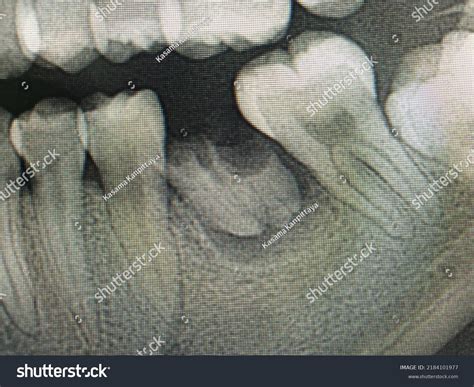 20 Periapical Film Images, Stock Photos & Vectors | Shutterstock
