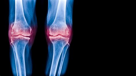 Regenerating Knee Joints with Stem Cell Therapy in Tijuana - CRC