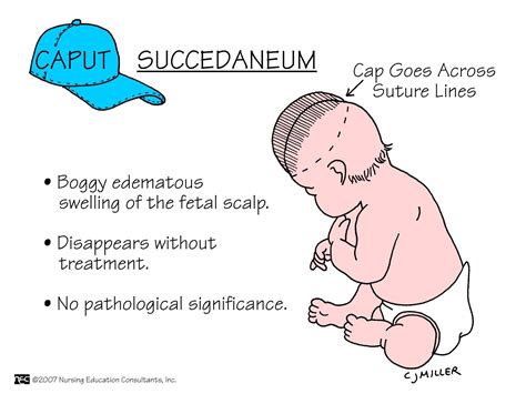 Cephalohematoma Vs Caput Succedaneum