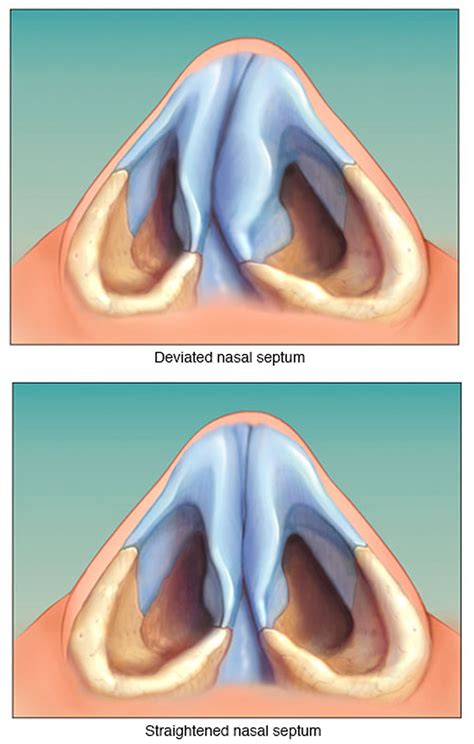 Deviated Septum - Causes, Symptoms, How To Fix A Deviated Septum
