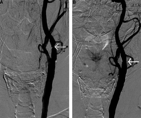 Carotid Artery Disease | Circulation