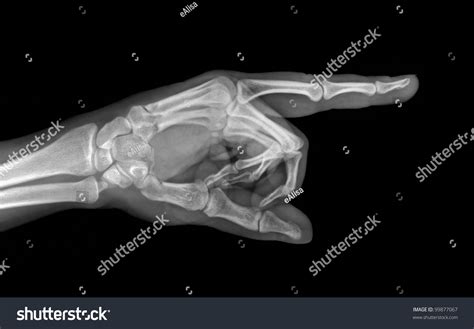 Broken Hand Xray: Over 3,073 Royalty-Free Licensable Stock Photos ...
