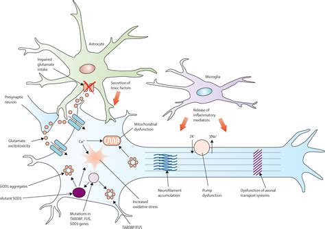 Amyotrophic lateral sclerosis - The Lancet